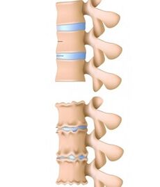 columna saudable e columna vertebral afectada por osteocondrose