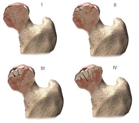 etapas de artrose da articulación da cadeira