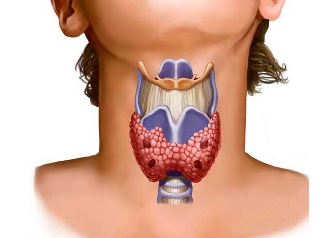 problemas de tireóide como causa da dor no pescozo