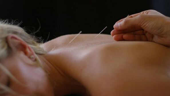 acupuntura para a dor de costas