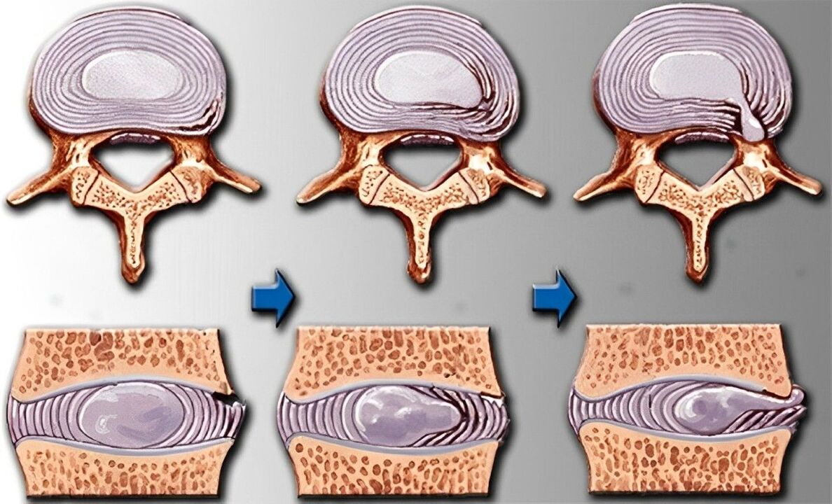 fases da osteocondrose