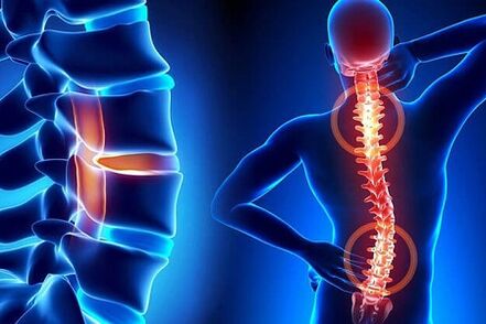 osteocondrose