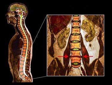 Disco dexenerativo na columna vertebral