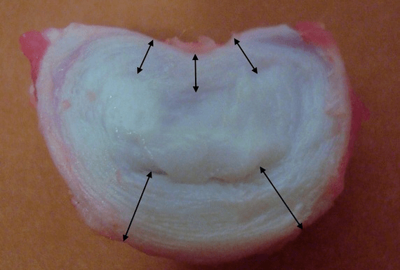 que aspecto ten un disco intervertebral