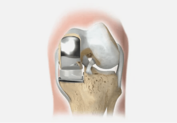 unha parte da articulación está danada