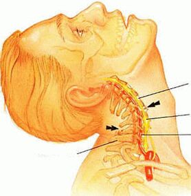 Osteocondrose da columna cervical